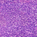 Adenocarcinoma ventriculi (diffuse type) 0