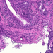 bronchus-metaplasia-dysplasia-carcinomaátmenet