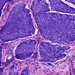 carcinoma basocellulare 1