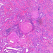 adenocarcinoma prostatae1