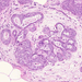 carcinoma ductale invasivum mammae in situ