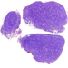 follicularis lymphoma (HE)