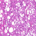 liposarcoma-lipoblastok