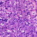 Adenocarcinoma ventriculi (diffuse type) pecsétgyurur2