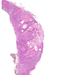 carcinoma planocellulare cutis