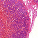 neuroblastoma1